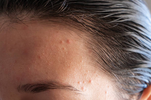 Discover the Causes of Forehead Acne: Hormonal Imbalance, Stress, Diet, and More - Expert Advice