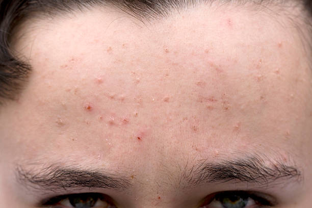 Why am I Breaking Out on My Forehead? Discover the Causes and Solutions