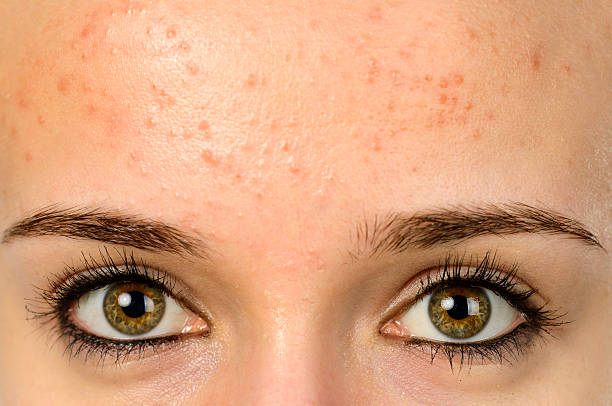 Discover the Different Types of Forehead Acne - From Whiteheads to Cystic Acne